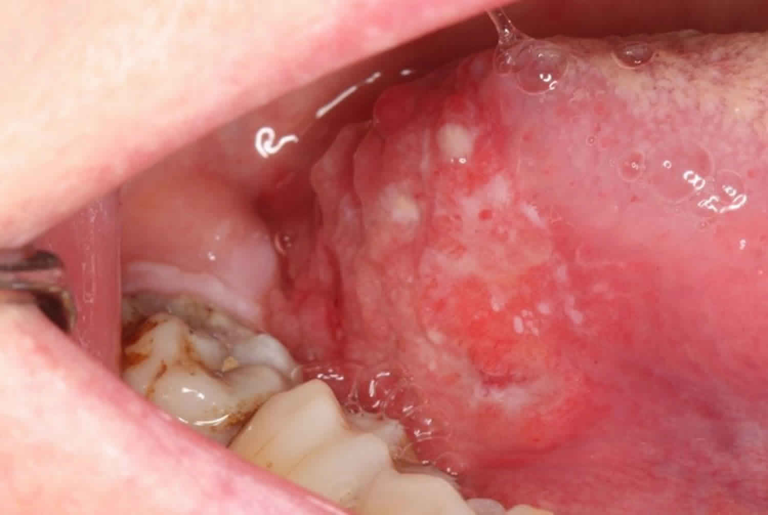 Causes, symptoms and treatment of mouth cancer