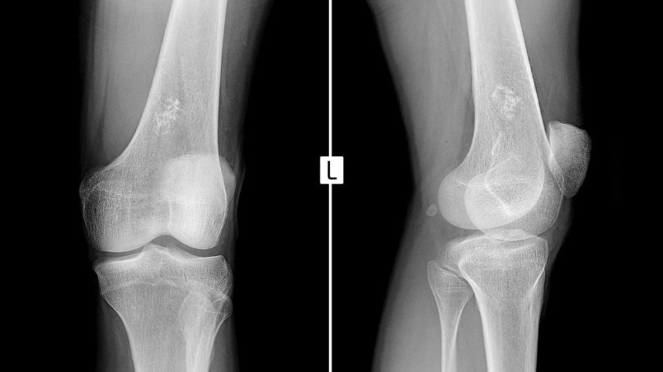 Symptom, causes and treatment of Ewing Sarcoma