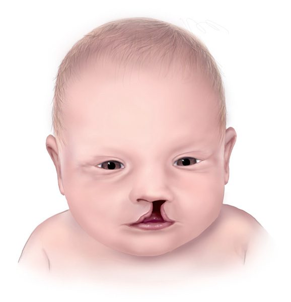 Symptoms, causes and treatment of Trisomy 13