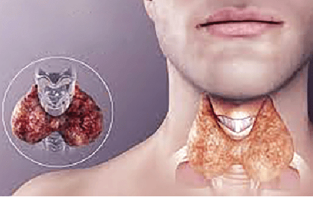 Hyperthyroidism (overactive thyroid)