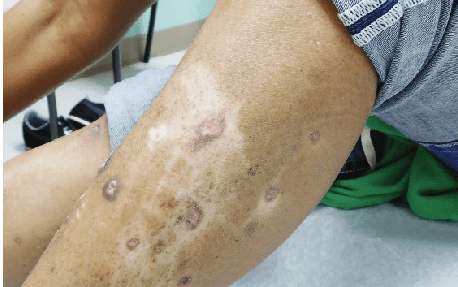 Lichen planus