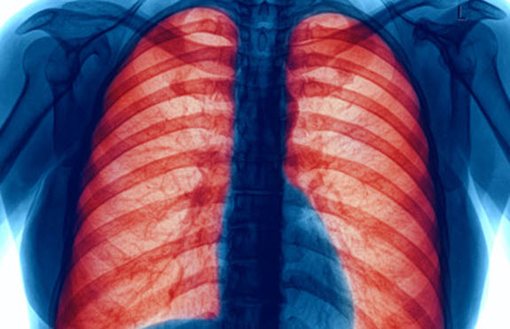 Chronic Obstructive Pulmonary Disease (COPD)