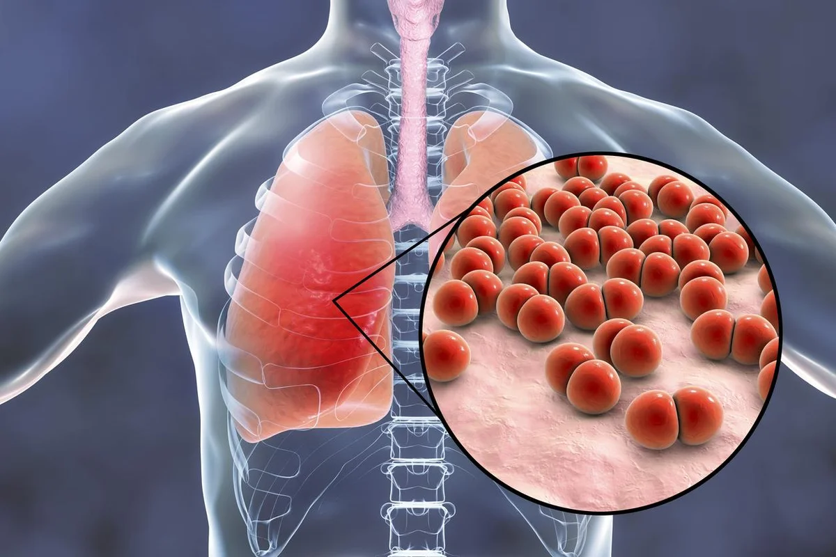 Pneumococcal disease